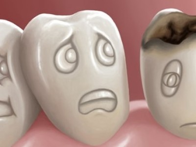 Diş Çürüğü Nasıl Oluşur?